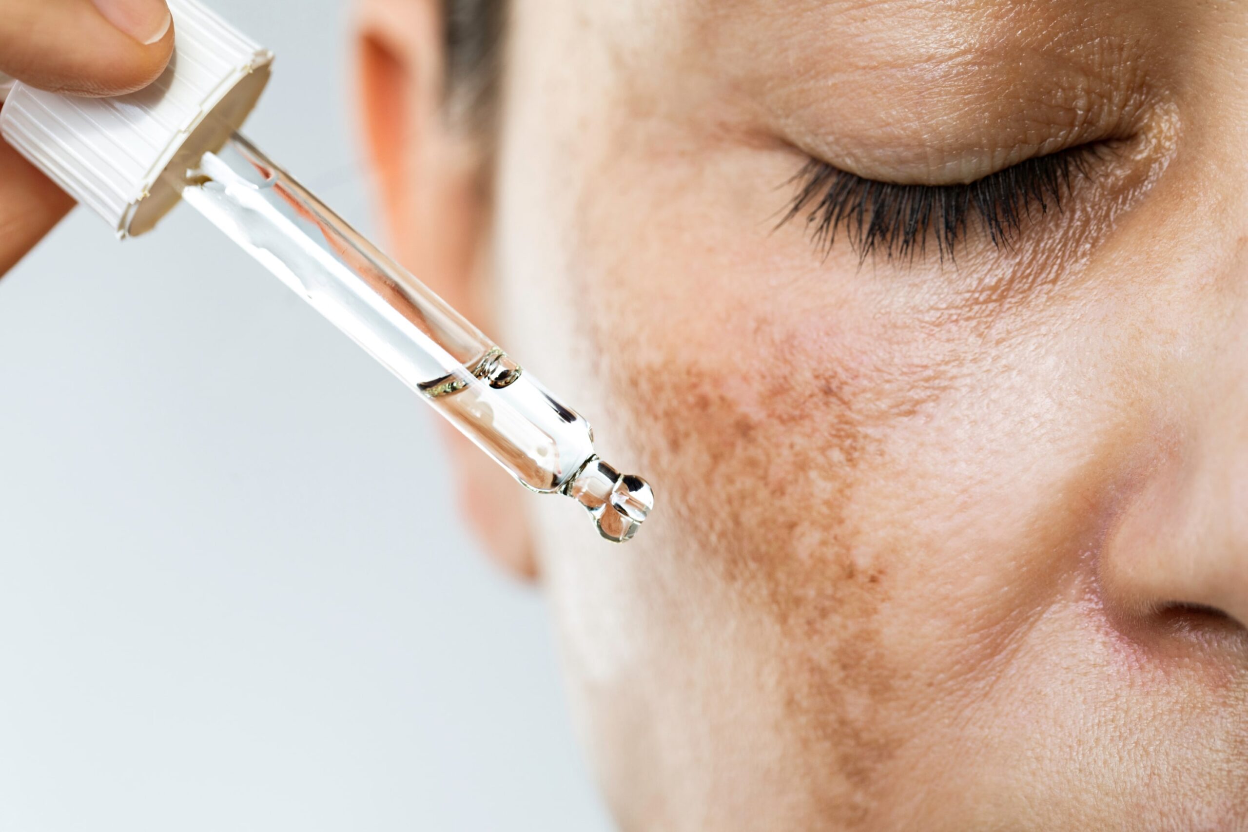 Personalisation of hyperpigmentation treatments lady with hyperpigmentation and natural oil pipette 