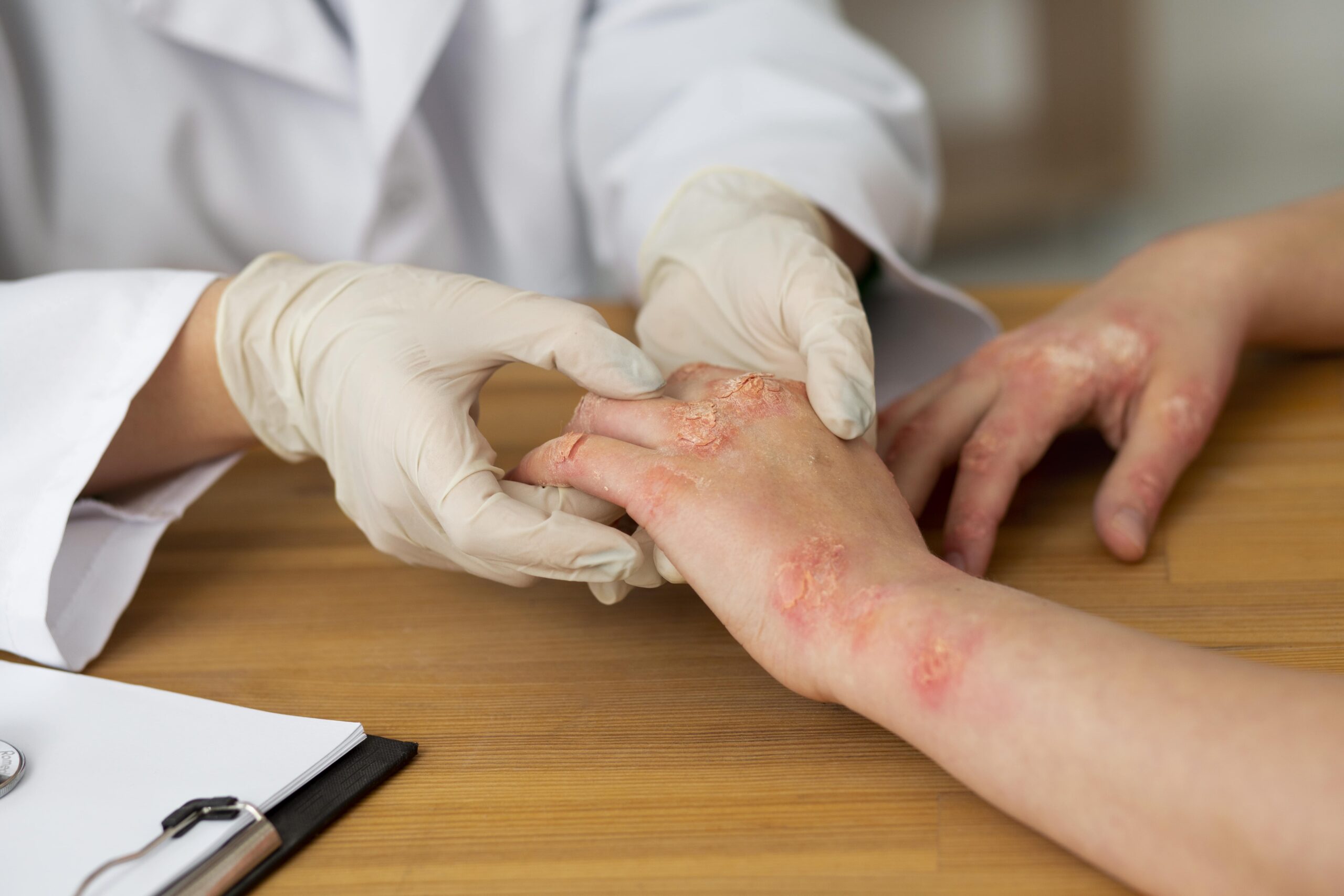 hands of doctor in gloves and patient with psoriasis