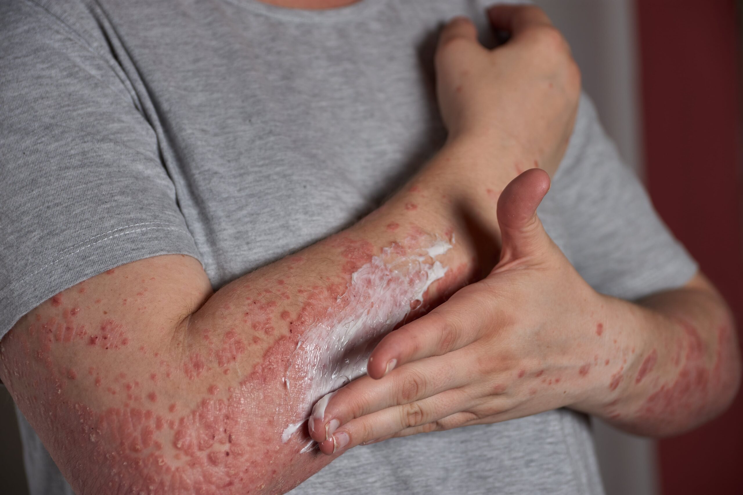 psoriasis suffers arm with moisturiser being applied